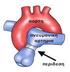 Περίδεση πνευμονικής