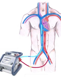 ECMO_PICTURE